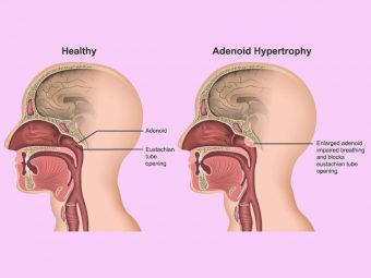 Enlarged Adenoids In Children Symptoms, Removal, And Treatment-2