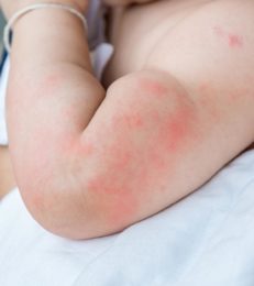 Hives On Baby: Causes, Symptoms, Treatment And Prevention
