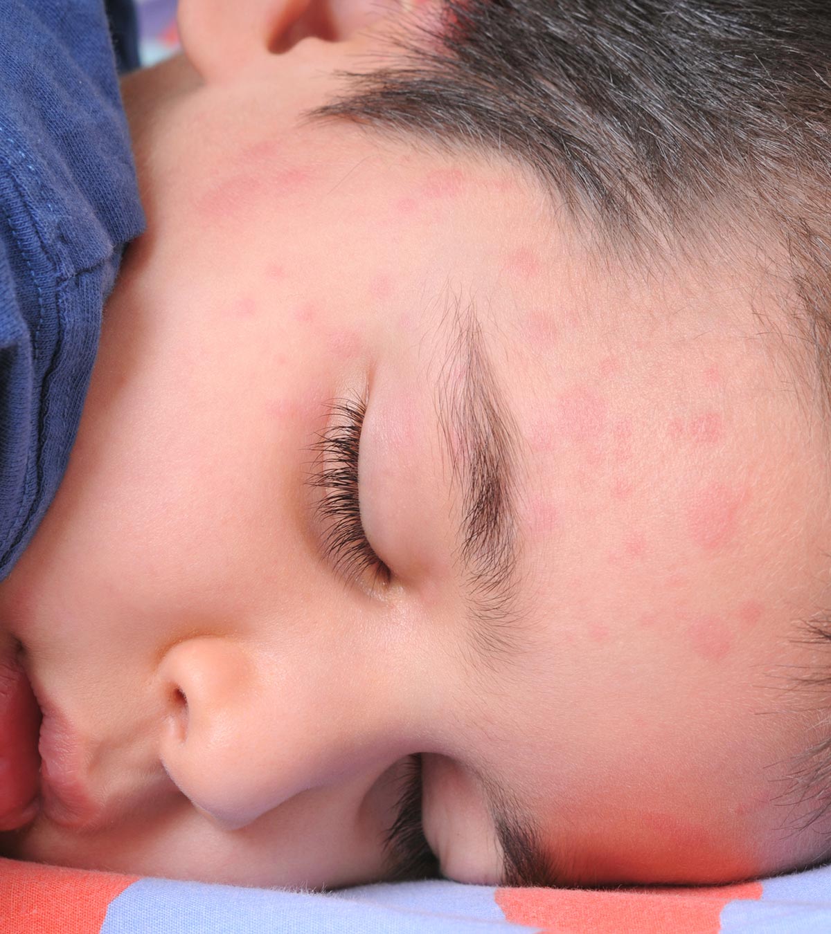 What Are Hives In Children: Causes, Symptoms, And Treatment