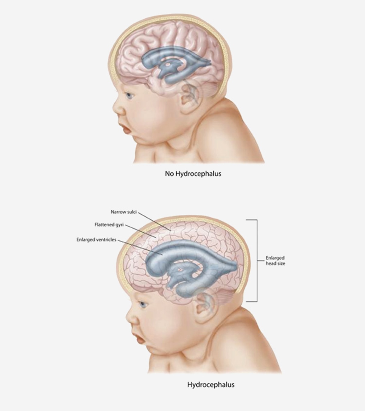 Hydrocephalus In Babies: Causes, Symptoms & Treatment