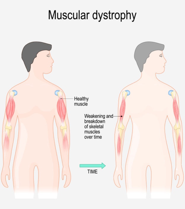 Muscular Dystrophy In Children: Types, Causes, Signs And Treatment