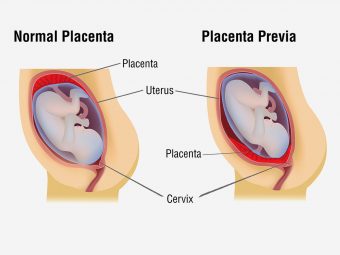 Placenta-Previa-Causes,-Symptoms-And-Treatment1