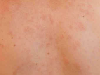 Pityriasis Rosea In Children: Causes, Symptoms, And Treatment 