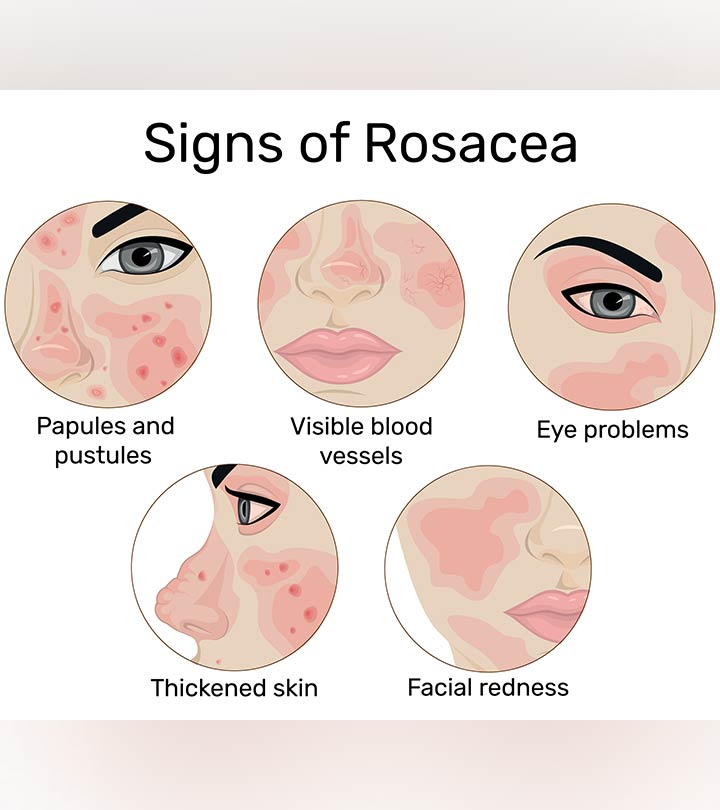 Rosacea In Children: Causes, Symptoms, Treatment And Prevention